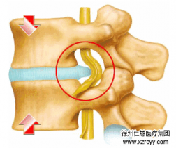 【脊柱】腰突不看年龄，生活习惯是关键！