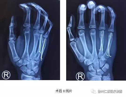 术后