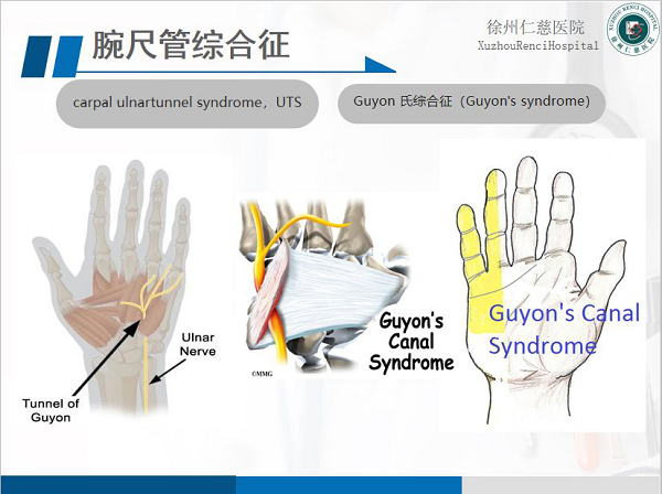 腕尺管综合征