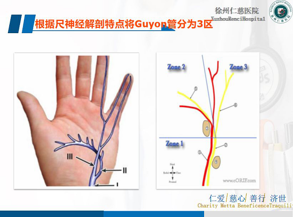 腕尺管综合征