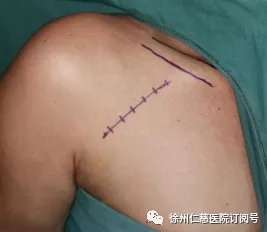 仁慈手外