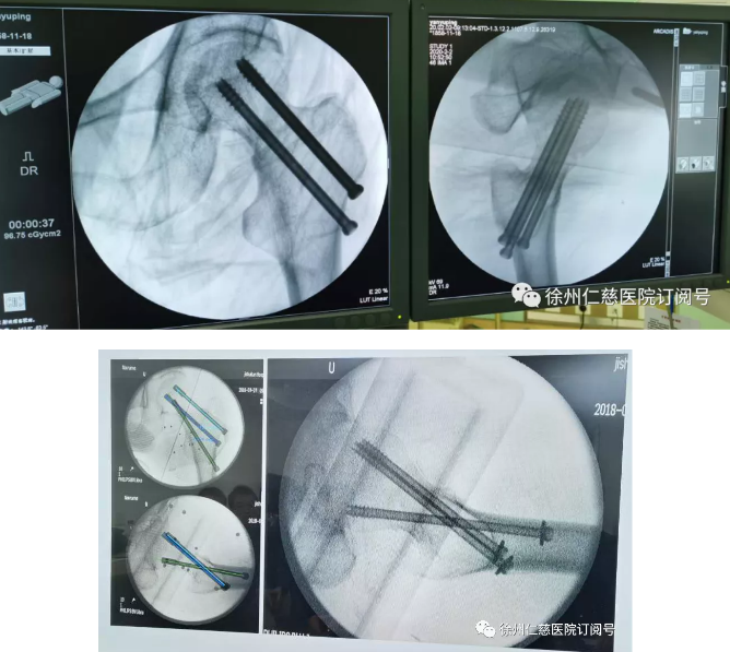 徐州仁慈医院骨科机器人