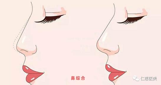 鼻综合