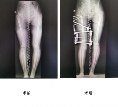 花季少女跛行15年，仁慈骨科利用Ilizarov技术帮其健康行走