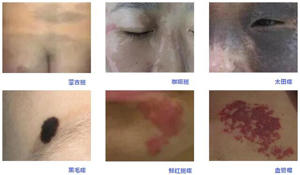 血管瘤