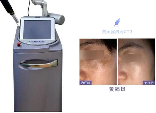 血管瘤