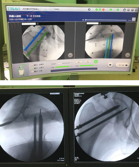 仁慈骨科机器人