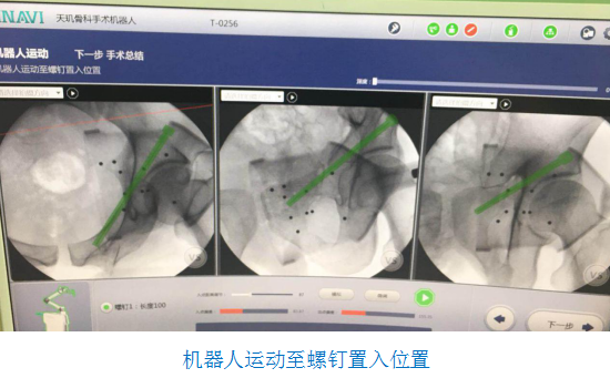 骨科机器人