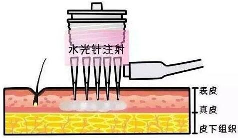 水光针