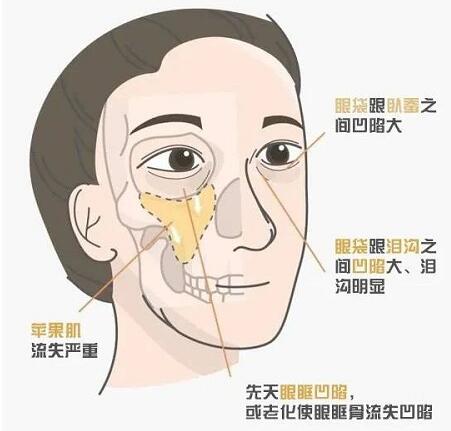 黑眼圈