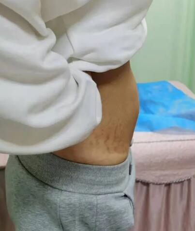 腹直肌分离