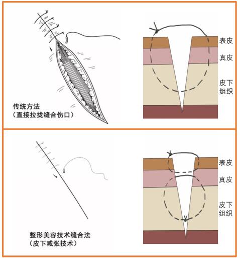 美容缝合