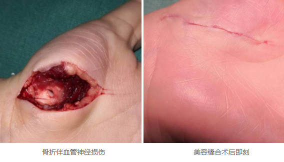 外伤美容缝合:既要功能性恢复,还要"伤口了无痕"-手外科--徐州仁慈