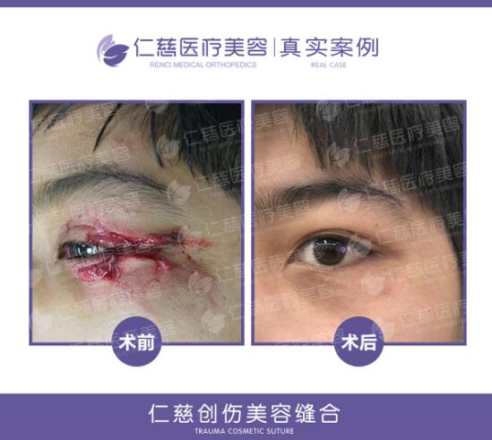 创伤美容缝合免拆线我想你是误会了